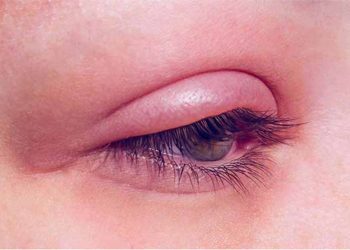 عوارض لیفت مژه