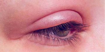 عوارض لیفت مژه