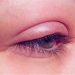 عوارض لیفت مژه