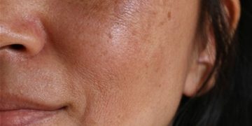 چه عواملی سبب کدر و تیره شدن پوست می‌شوند؟