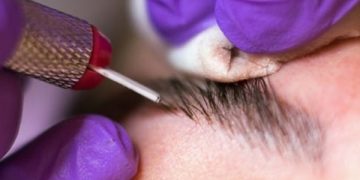 نقش انواع پوست برای انجام فیبروز ابرو