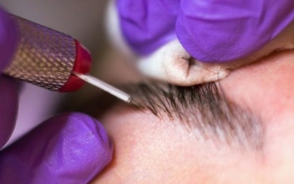 نقش انواع پوست برای انجام فیبروز ابرو