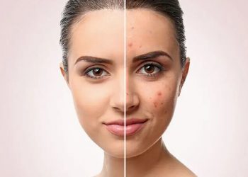 13 داروی خانگی قدرتمند برای درمان آکنه