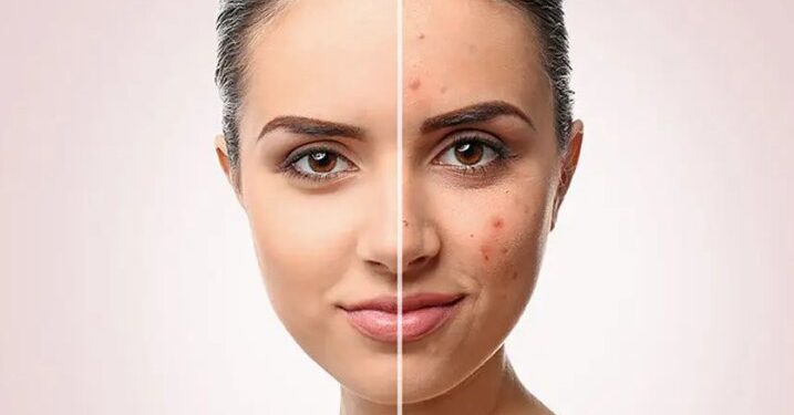 13 داروی خانگی قدرتمند برای درمان آکنه