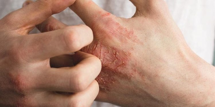 اگزمای دست، بررسی علل، تشخیص و درمان