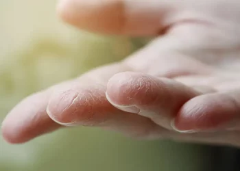 ایجاد خشکی دستها بر اثر شستشوی زیاد و راههای درمان آن