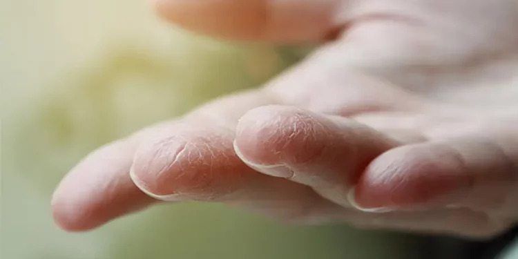 ایجاد خشکی دستها بر اثر شستشوی زیاد و راههای درمان آن