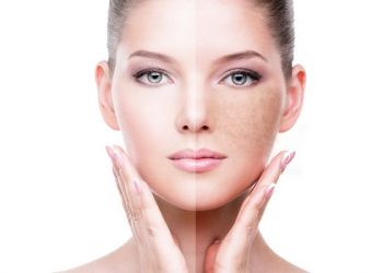 آکانتوز نیگریکانس (تیرگی پوست) چیست؟