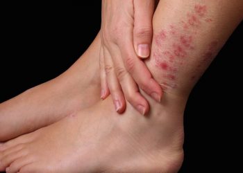 بیماری پسوریازیس یا صدف psoriasis