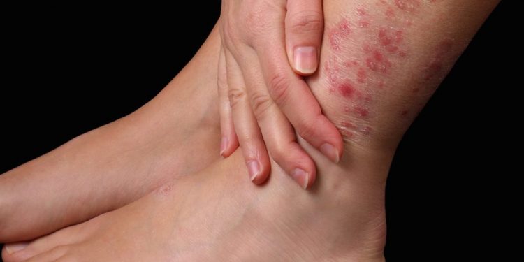 بیماری پسوریازیس یا صدف psoriasis