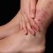 بیماری پسوریازیس یا صدف psoriasis