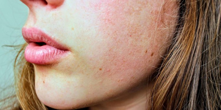 چه چیزی باعث ایجاد لکه های خشکی پوست می شود؟
