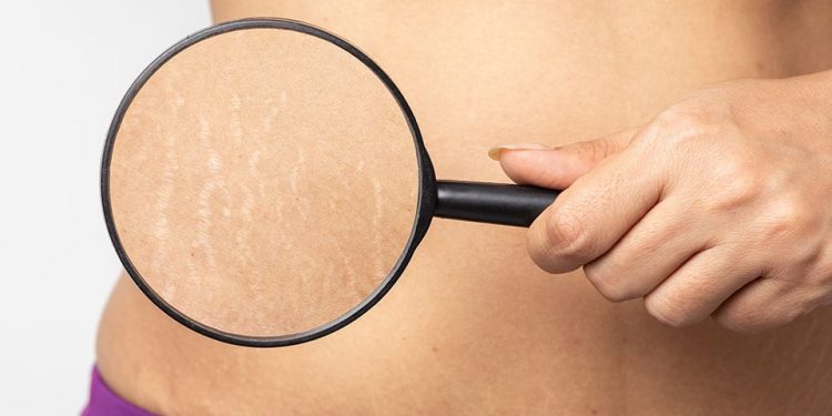 ترک پوستی چیست؟