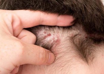 جوش کف سر؛ دلایل و درمان