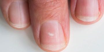 خطوط سفید روی ناخن چرا ایجاد می شود؟