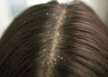 شوره سر | شناخت انواع شوره، علل ایجاد و راهکارهای درمانی