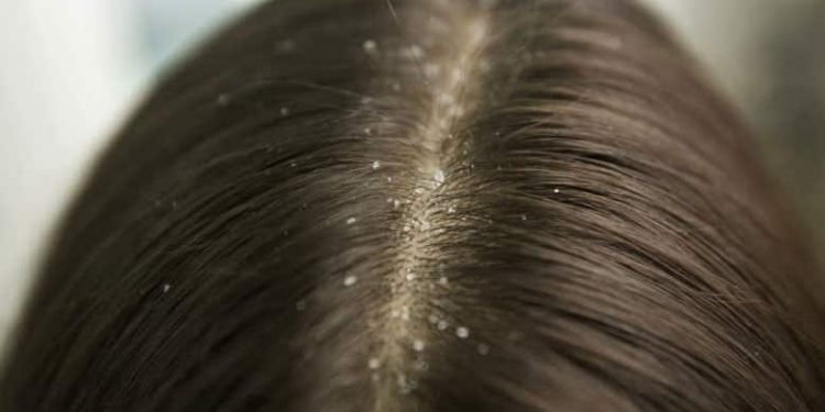 شوره سر | شناخت انواع شوره، علل ایجاد و راهکارهای درمانی