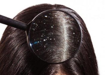 درمان شوره سر