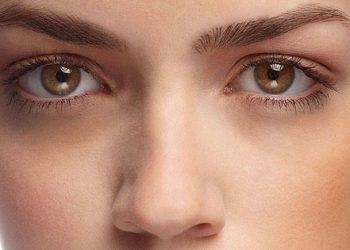 راه های پیشگیری و درمانهای خانگی و کلینیکی تیرگی زیر چشم