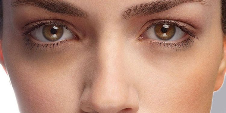 راه های پیشگیری و درمانهای خانگی و کلینیکی تیرگی زیر چشم