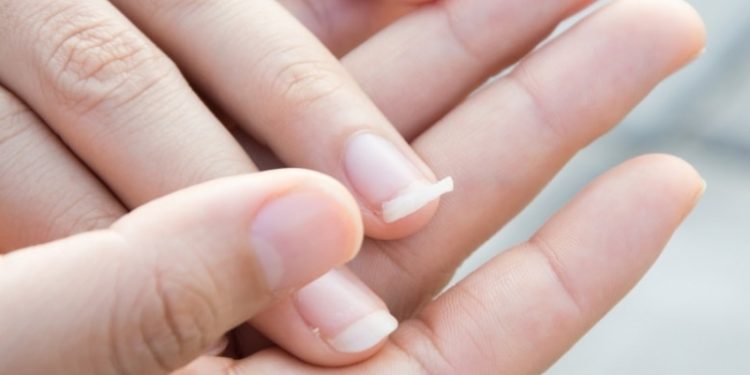 ۸ دلیل اصلی شکنندگی ناخن و روش های درمان ناخن های شکننده