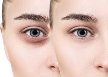 سیاهی زیر چشم دلیل و درمان!