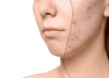 از بین بردن جای جوش؛ ۱۴ ماده طبیعی و خانگی که صورت شما را پاکسازی میکند