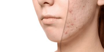از بین بردن جای جوش؛ ۱۴ ماده طبیعی و خانگی که صورت شما را پاکسازی می‌کند