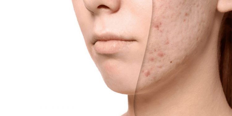 از بین بردن جای جوش؛ ۱۴ ماده طبیعی و خانگی که صورت شما را پاکسازی می‌کند