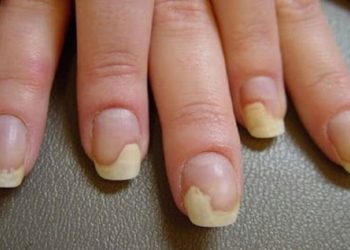 بد شکلی ناخن