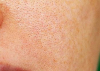 درمان پوست پرتقالی و بستن منافذ باز پوست