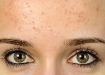 بهترین درمان های خانگی برای کاهش جوش و آکنه روی پیشانی