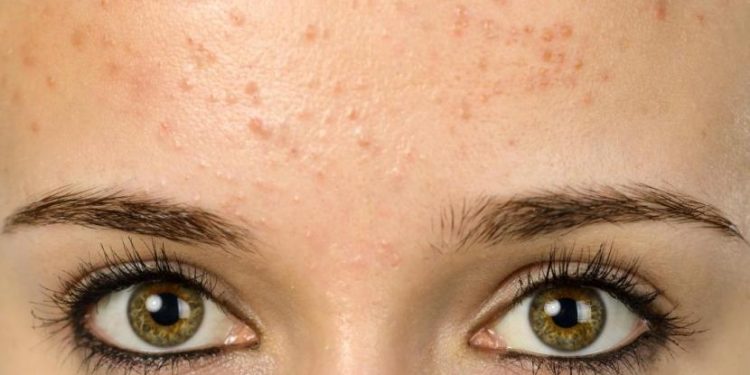 بهترین درمان های خانگی برای کاهش جوش و آکنه روی پیشانی