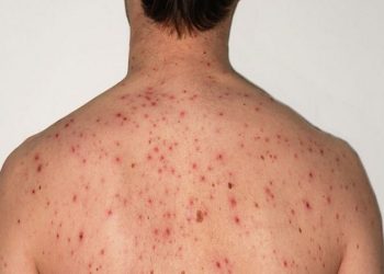 علل و راههای درمان خانگی جوش پشت ، کمر و سرشانه