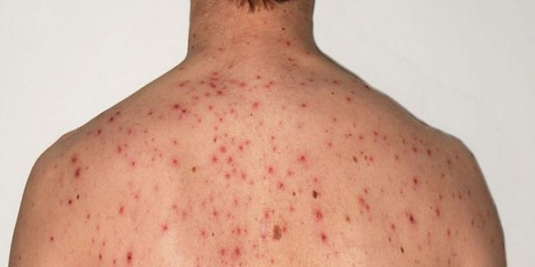 علل و راههای درمان خانگی جوش پشت ، کمر و سرشانه