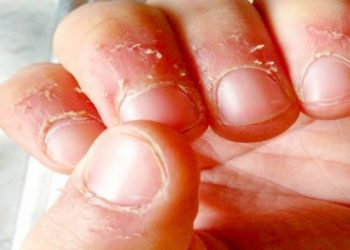 علت پوسته شدن اطراف ناخن و راههای درمان گیاهی و خانگی آن