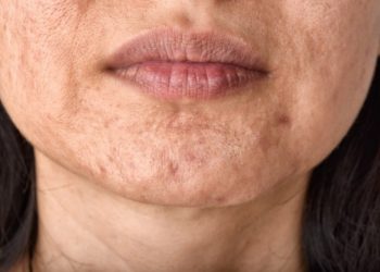 آکنه و جوش چانه – علل و بهترین گزینه های درمان