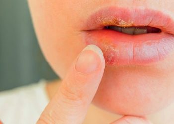 سریعترین راه درمان تبخال روی لب با روش های خانگی