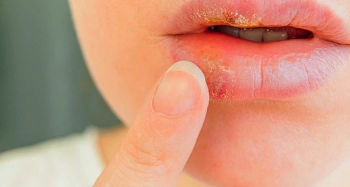 سریعترین راه درمان تبخال روی لب با روش های خانگی