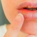 سریعترین راه درمان تبخال روی لب با روش های خانگی