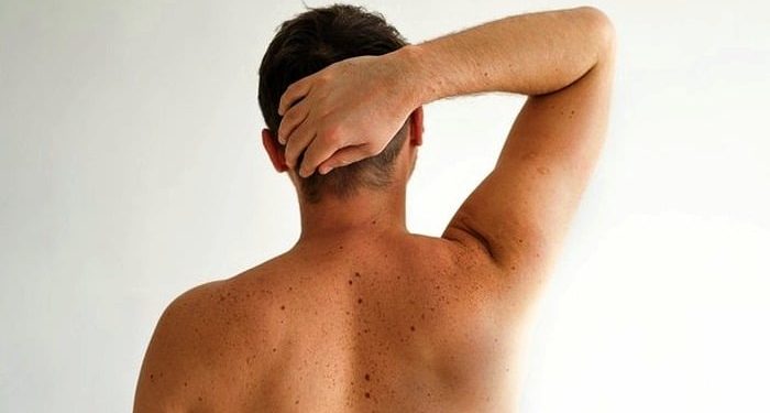 درمان های خانگی برای درمان و پاک کردن لکه های کبدی که عالی هستند