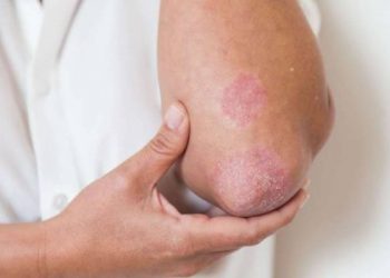 قارچ پوستی چیست ؟ چه علائمی دارد و چطور درمان می شود؟