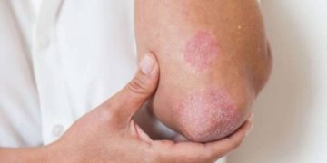 قارچ پوستی چیست ؟ چه علائمی دارد و چطور درمان می شود؟