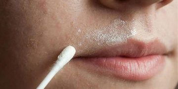 روش های موثر برای رفع موهای پشت لب با مواد گیاهی در منزل
