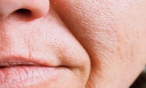 ماساژ خط خنده: از بین بردن خط خنده با ماساژ