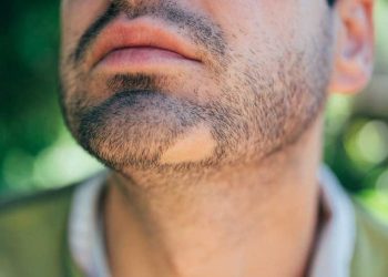 ریزش سکه ای ریش یا صورت | علل و روش های درمان