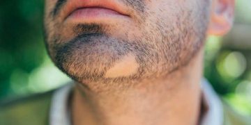 ریزش سکه ای ریش یا صورت | علل و روش های درمان