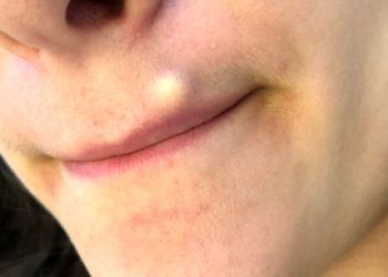 کیست پوستی صورت؛ علائم، دلایل و درمان‌های خانگی