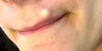 کیست پوستی صورت؛ علائم، دلایل و درمان‌های خانگی
