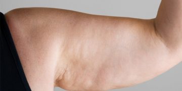 قاتل سلولیت چیست؟ چگونه از شر سلولیت خلاص شویم؟